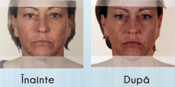 acid hialuronic pe frunte Definiție elvețiană pentru IMM anti-îmbătrânire
